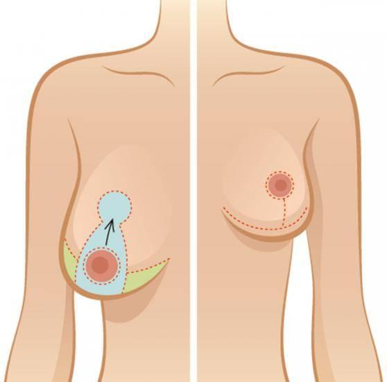 Bild Brustverkleinerung